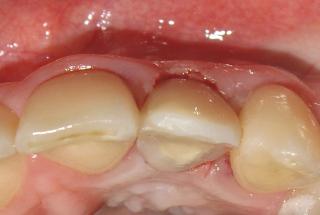 Vista oclusal de diente provisional inmediato.