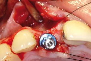 Colocación de implante IPHE413.