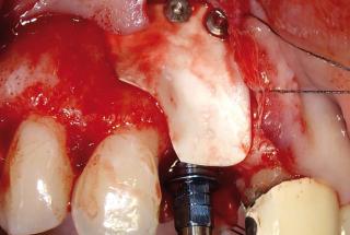 Aumento de volumen vestibular mediante injerto óseo y membrana reabsorbible de colágeno, fijada mediante suturas y chinchetas de Titanio.