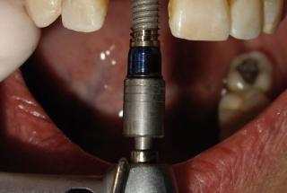 Colocación de implante IPHE415.
